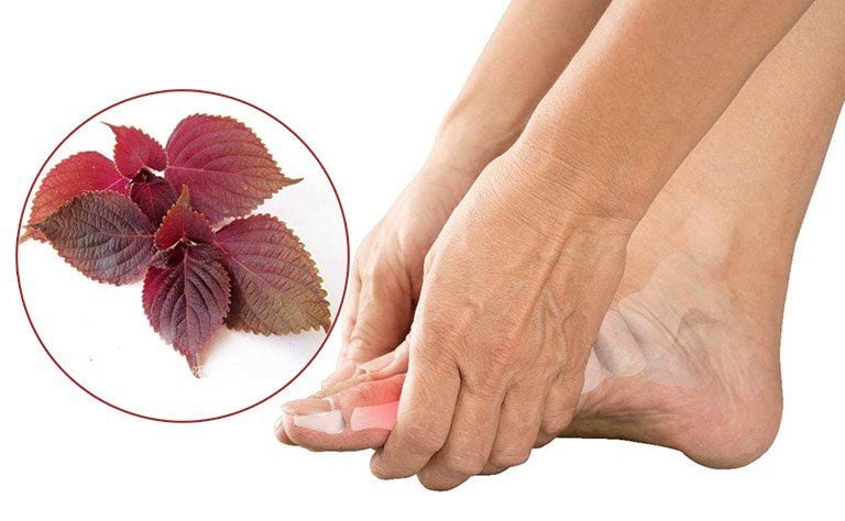 Tác dụng của lá tía tô đối với bệnh gout theo Đông y và góc nhìn y học hiện đại